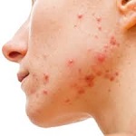 acne2.jpg