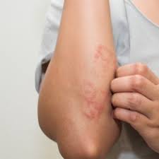 eczema2.jpg